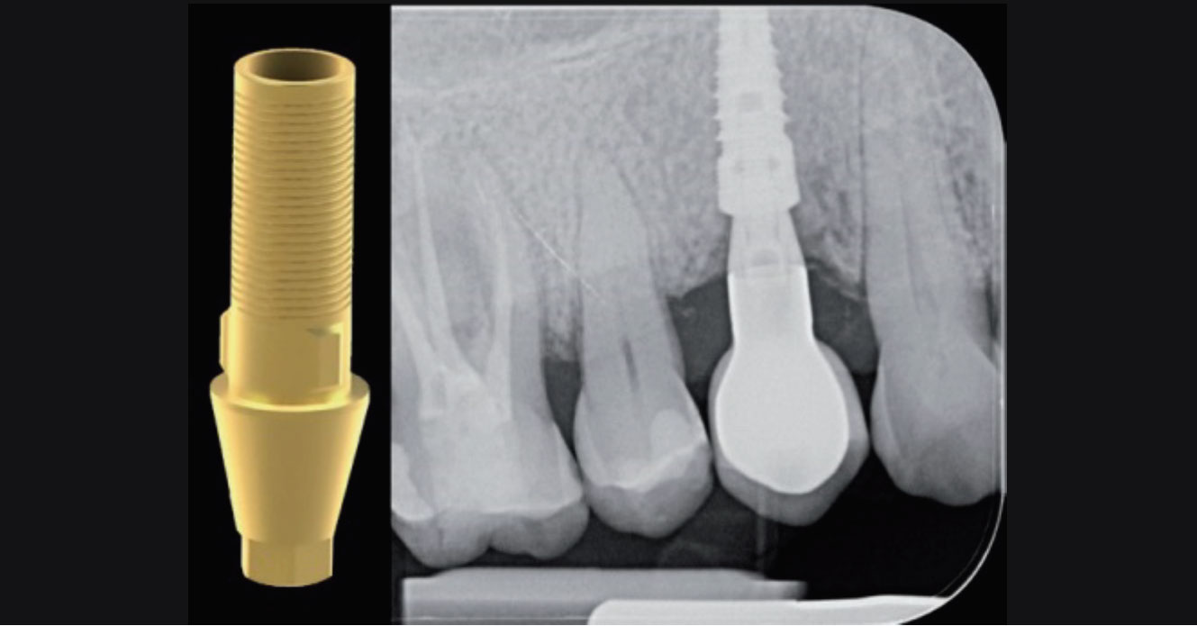 Intraoral x-ray for checking the proper matching
