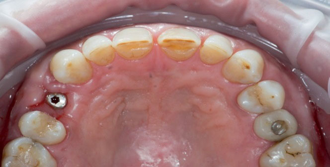 Occlusal photograph after the insertion