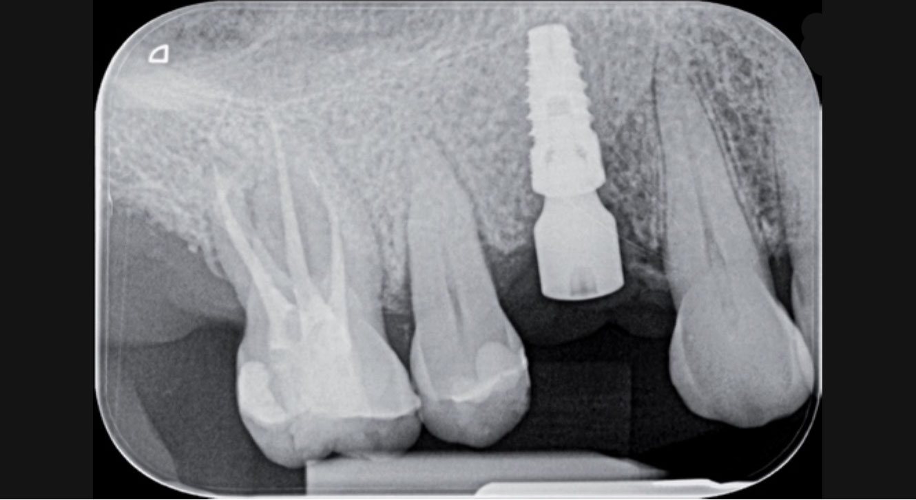 Intraoral x-ray to check the peri-implant bone